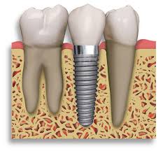 Dental-Implants-Central-Jersey-Dental-Monroe-Township-NJ-08831-b