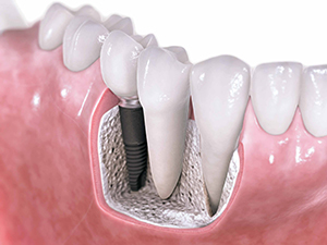 Dental-Implants-Central-Jersey-Dental-Monroe-Township-NJ-08831