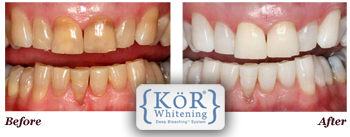 KöR Whitening Deep Bleaching Central Jersey Dental in Monroe Township NJ 08831