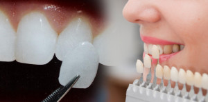 Porcelain Dental Veneers in Monroe Township, NJ