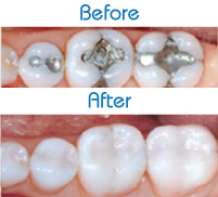 tooth-colored-white-fillings